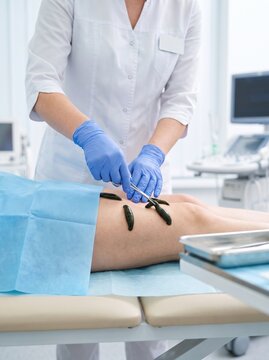 Medicinal Leeches Applied During Medical Treatment