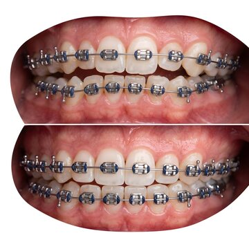 Clinical Dental Comparison of Teeth Straightening Progress During Braces Treatment