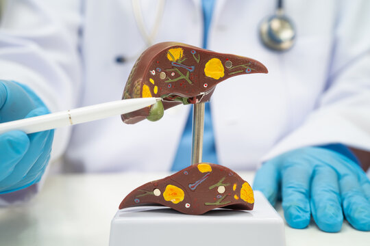 Cirrhosis, Liver cancer, fatty liver, Asian doctor with liver human anatomy model in World Hepatitis Day at hospital.