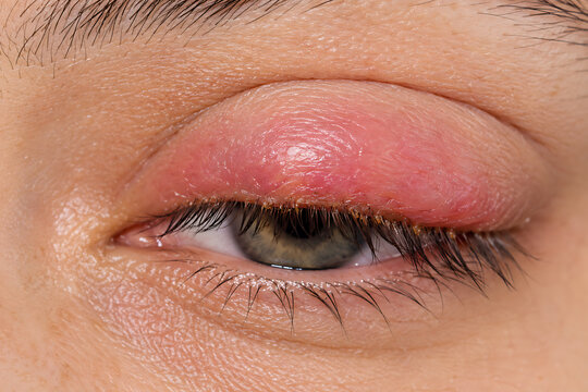 Close Up of Red Swollen Eyelid with Inflamed Skin and Eye Irritation