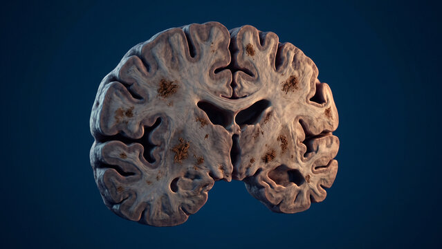 Brain cross section showing cerebral cortex atrophy and localized lesion spots stands out on a dark blue studio background.