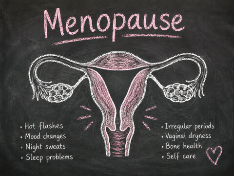 Educational chalkboard illustration of female reproductive anatomy and common menopause symptoms, representing hormonal changes, midlife health and gynecological education