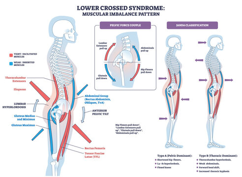 Lower crossed syndrome mechanics show muscle imbalance causing anterior pelvic tilt and lumbar hyperlordosis, key elements are spine, pelvis, and hip flexors. Diagram