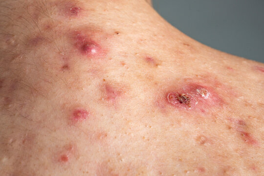 Acne pimple with pus center. Acne pimple and sore redness. Dermatology closeup, acne pimple lesion. Human skin macro acne pimple.