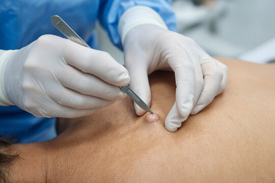 dermatologo ciste cisti operazione bisturi 