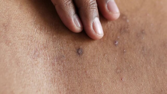 A person&rsquo;s hand gently touching their back showing various skin lesions and imperfections, close-up shot of human skin texture