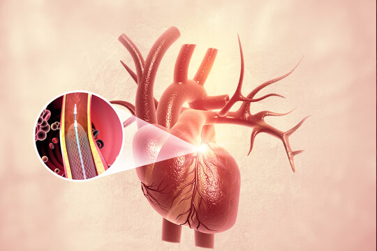 3D medical illustration demonstrating a coronary stent implant during a human heart angioplasty procedure to open arteries.