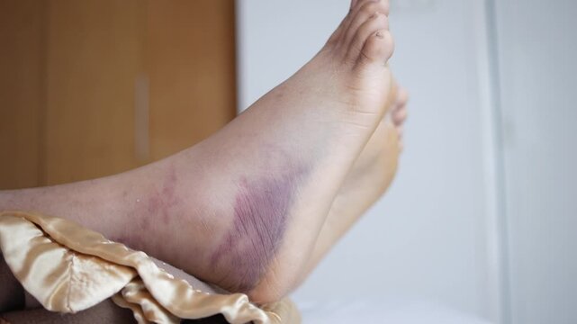 Close up video of injured swollen ankle with bruise on foot, female leg with painful injury, woman experiencing swelling and discoloration after sprain