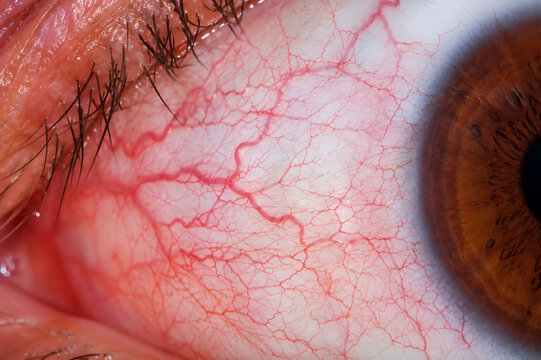 Bloodshot Red Human Eye With Visible Veins and Brown Iris Close Up