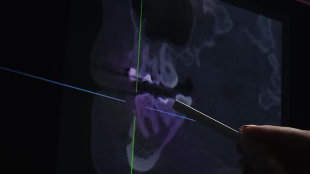 A dentist's hand pointing at a 3D dental scan on a digital screen showing jaw and teeth structure with measurement lines. High quality 4k footage