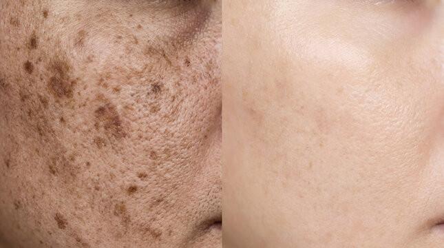 Macro before and after comparison of hyperpigmentation and dark spots skin brightening treatment