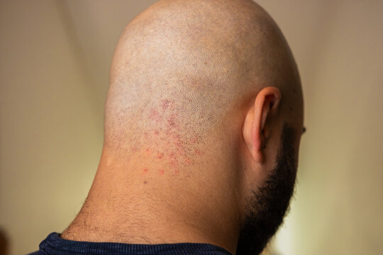 Irritated skin after shaving. Irritated scalp after head shave. Irritation after shaving. Skin irritation