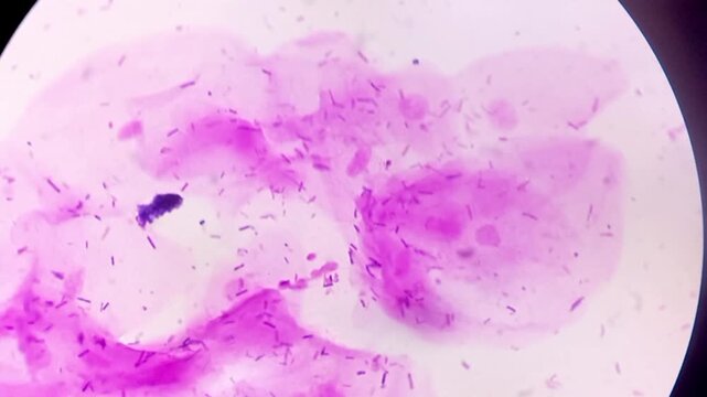 HVS for gram stain. Gram positive bacilli resembling lactobacilli.