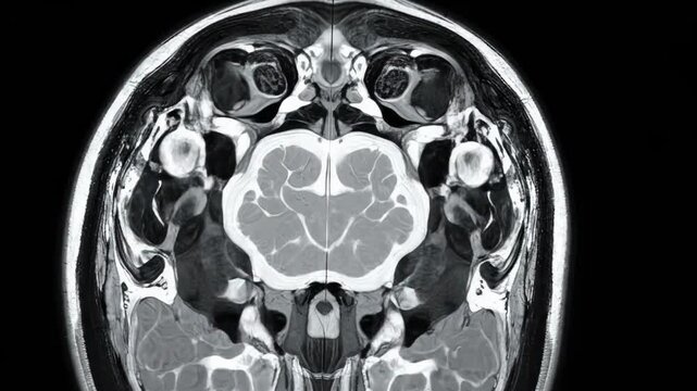 Detailed coronal MRI brain scan showcasing intricate neural structures ideal for medical presentations, educational content, and healthcare marketing materials.