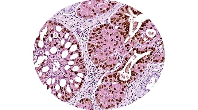 Microscopic view of a histological tissue sample with immunohistochemistry staining showing brown nuclear expression in cellular structures for medical research and pathology diagnostic analysis.