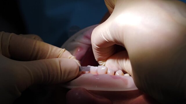 Close-up of dentist gloved hands pressing temporary veneers onto front incisors. Clear retractor holds lips apart. Final placement stage of cosmetic dental restoration process 4k video