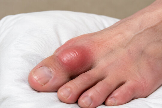 Swollen big toe joint on white cushion, gout and inflammation concept