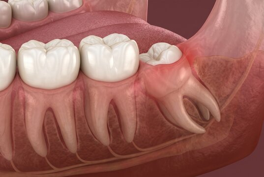 埋伏智歯による歯肉の腫れを表す歯科3DCG断面図