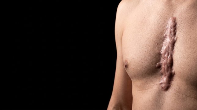 Large Raised Sternotomy Keloid Scar on Male Chest After Open Heart Surgery