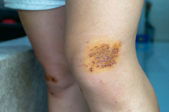 Healing knee abrasion covered dry scab antiseptic iodine after injury representing first aid wound treatment skin care recovery