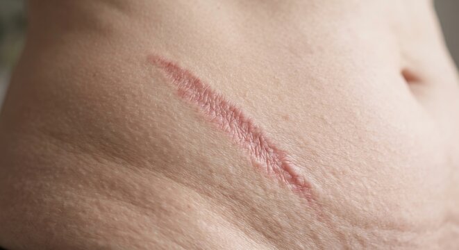 Surgical scar and keloid tissue on lower abdomen skin close up