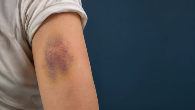 Bruise on human arm showing skin discoloration, injury trauma and hematoma health care