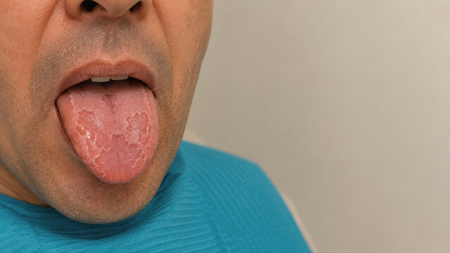 geographic tongue showing benign migratory glossitis and red patches on human tongue close up