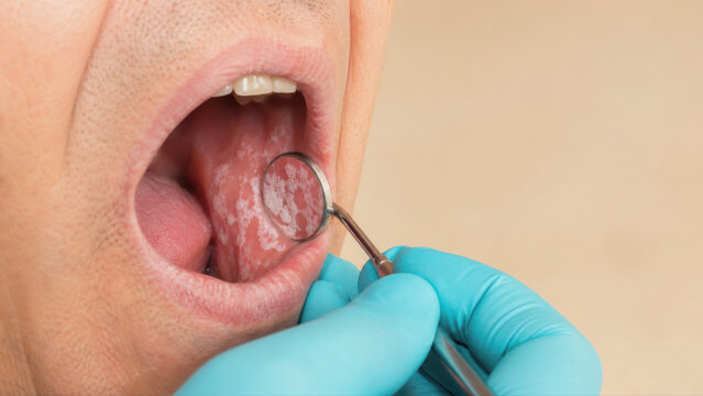 Oral candidiasis examination showing white patches on inner cheek with dental mirror