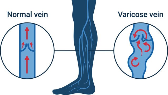 Comparison of varicose veins and normal vein, showing healthy valves and backward blood flow in human leg anatomy diagram