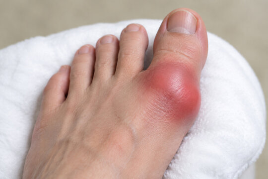 Swollen big toe joint on white cushion, gout and inflammation concept