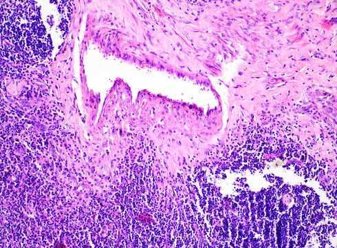 Tuberculosis is a chronic granulomatous inflammation characterized pathologically by tuberculous nodules, which consist of caseous necrosis, epithelioid cells, and macrophages.Magnify 200x.
