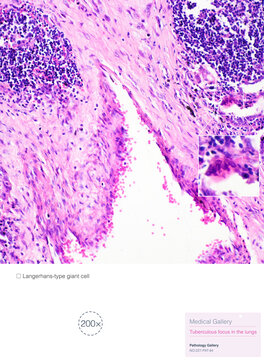Tuberculosis is a chronic granulomatous inflammation characterized pathologically by tuberculous nodules, which consist of caseous necrosis, epithelioid cells, and macrophages.Magnify 200x.
