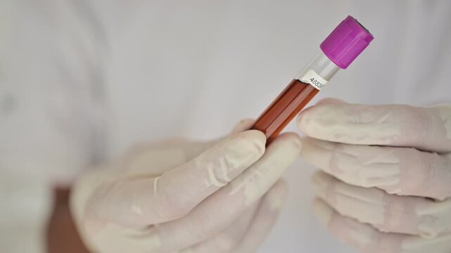 Tea-colored urine, a dark amber to brown urinary fluid with altered pigmentation, commonly described in clinical medicine and laboratory analysis as a concentrated or abnormal urine specimen

