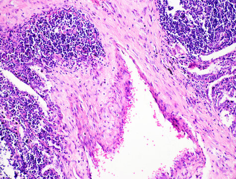 Tuberculosis is a chronic granulomatous inflammation characterized pathologically by tuberculous nodules, which consist of caseous necrosis, epithelioid cells, and macrophages.Magnify 200x.
