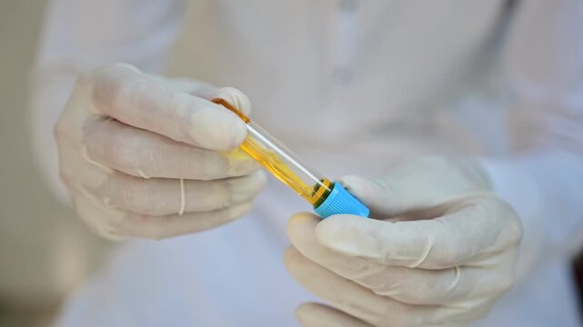 Synovial fluid, a clear viscous joint fluid containing hyaluronic acid, lubricating proteins, electrolytes, and cells that cushions joints and supports cartilage movement

