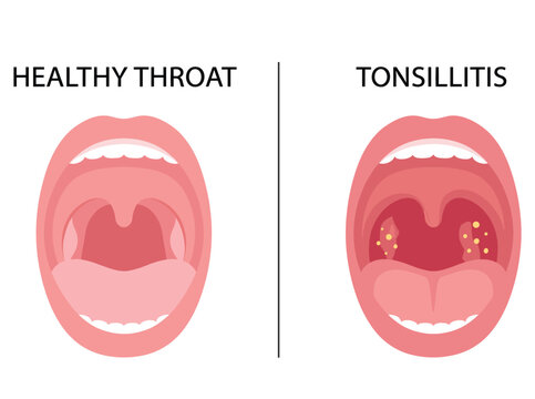 Healthy Throat and Tonsillitis Comparison Medical Illustration Showing Normal and Inflamed Tonsils