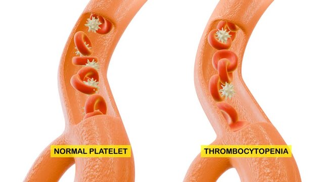 3D Animation of Thrombocytopenia. Suitable for presentation or college student learning.