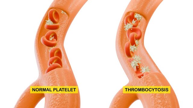 3D Animation of Thrombocytosis. Suitable for presentation or college student learning.