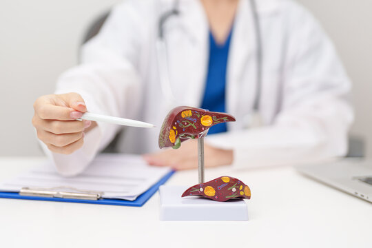 Doctor with human Liver anatomy model. Liver cancer and Tumor, Jaundice, Viral Hepatitis A, B, C, D, E, Cirrhosis, Failure, Enlarged, Hepatic Encephalopathy, Ascites Fluid in Belly and health concept