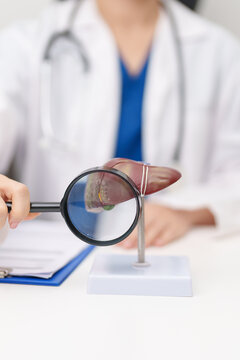 Doctor with human Liver anatomy model. Liver cancer and Tumor, Jaundice, Viral Hepatitis A, B, C, D, E, Cirrhosis, Failure, Enlarged, Hepatic Encephalopathy, Ascites Fluid in Belly and health concept