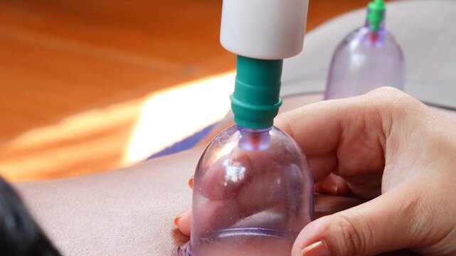 Close-up of cupping therapy on a man's back using a suction cup device for traditional wellness treatment at home.