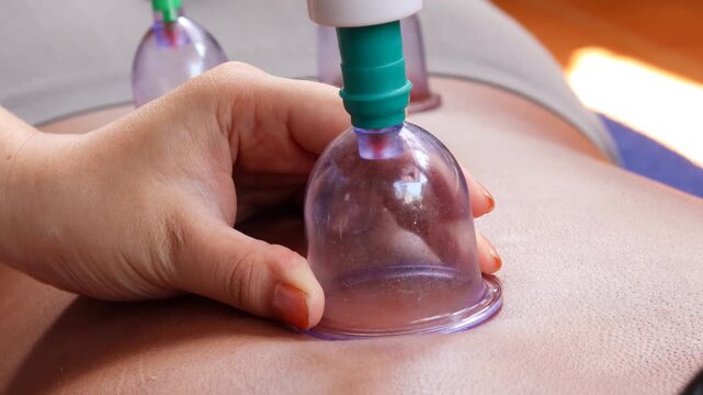 Close-up of cupping therapy on a man's back using a suction cup device for traditional wellness treatment at home.