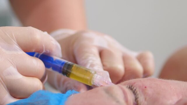 Cosmetologist hands performing plasma therapy (PRP) on woman face. Syringe holds yellow plasma. Natural regenerative treatment improving skin texture, tone and youthfulness 4k video