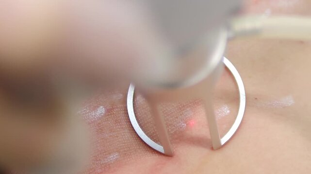 Laser skin rejuvenation procedure on female cheek. Red light beam stimulates deep tissue regeneration for smoother texture and youthful appearance. anti-aging beauty treatment in cosmetology. 4k shot