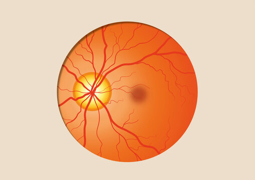 Glaucoma, illustration