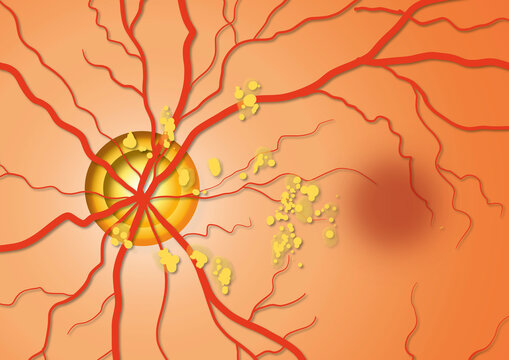 Dry macular degeneration, illustration