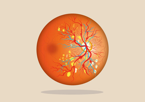 Diabetic retinopathy, illustration
