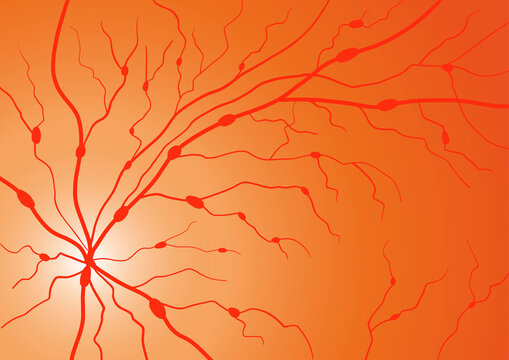 Retinal vein occlusions, illustration