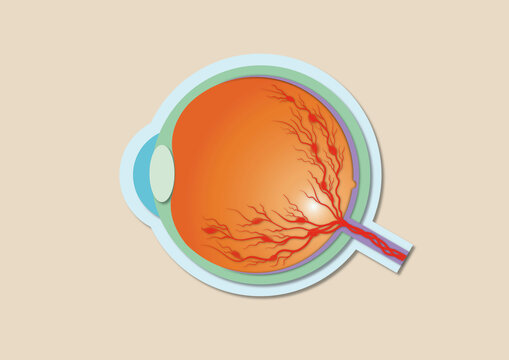 Retinal vein occlusion, illustration