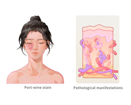 Port wine stain, illustration